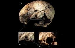 Operacja ucha sprzed 5 tys. lat? Intrygujące znalezisko w Hiszpanii