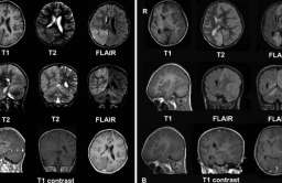 Obrazy mózgu wykonane metodą rezonansu magnetycznego
