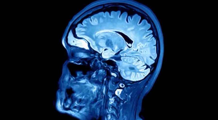 Obraz mózgu MRI