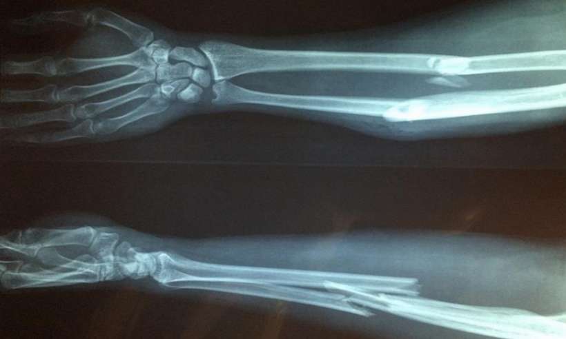 Obraz rentgenowski złamanej kości