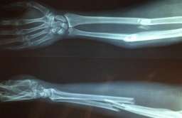 Obraz rentgenowski złamanej kości