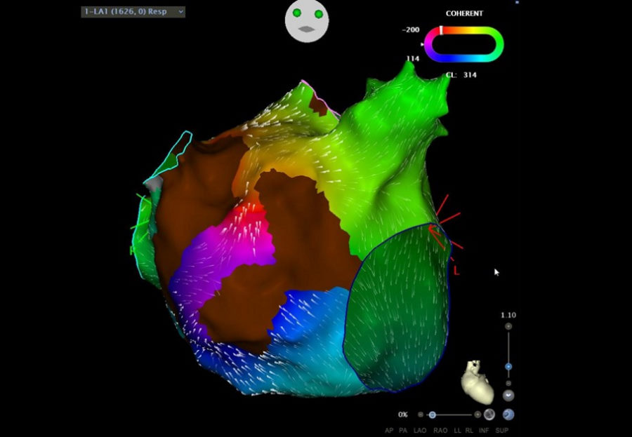 Przełomowa technologia mapowania serca 3D już w Polsce