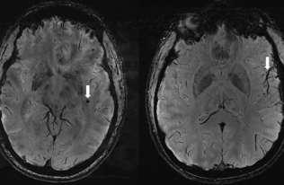 Zidentyfikowano zmiany w mózgach osób cierpiących na migreny. Nadzieja na nowe terapie