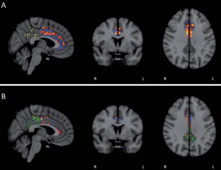 Tomografia komputerowa osoby chorej na Alzheimera