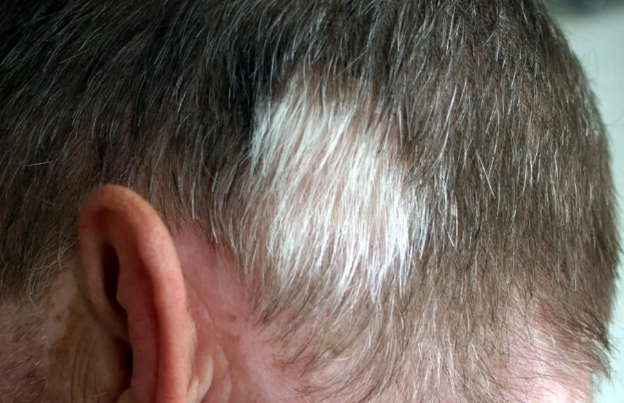 Różnokolorowe włosy od urodzenia? Czym jest poliosis?