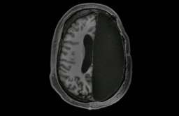 Skan MRI osoby z połową mózgu po hemisferektomii
