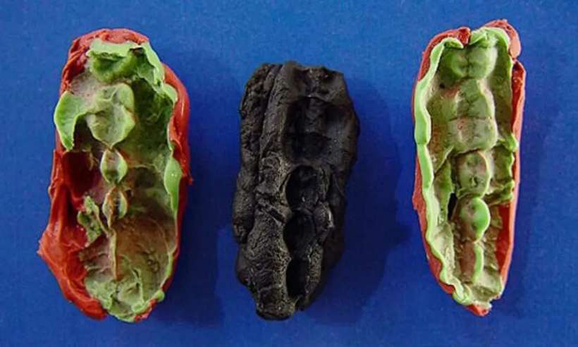 Starożytna „guma do żucia” rzuca światło na dietę z epoki kamienia