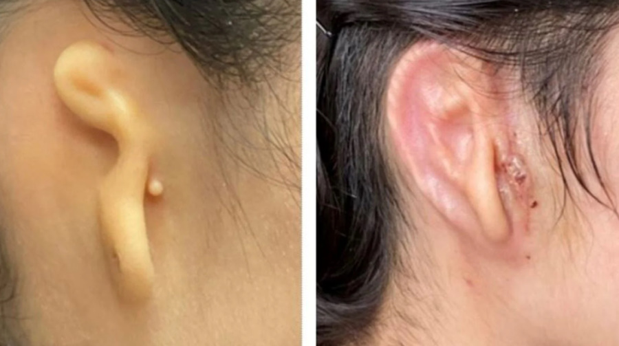 Lekarze wszczepili kobiecie ucho wydrukowane z jej własnych komórek
