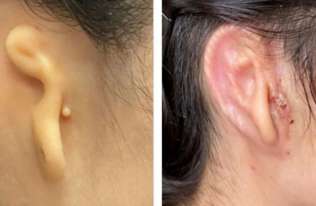 Lekarze wszczepili kobiecie ucho wydrukowane z jej własnych komórek